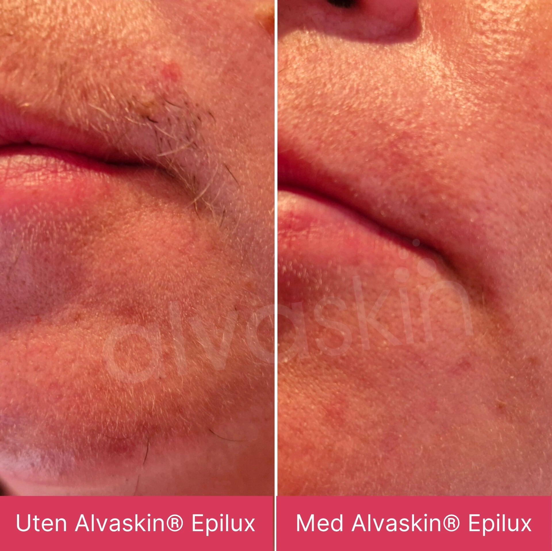 Alvaskin® Epilux