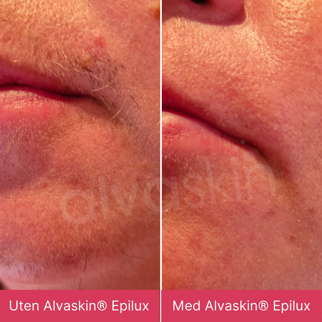 Alvaskin® Epilux
