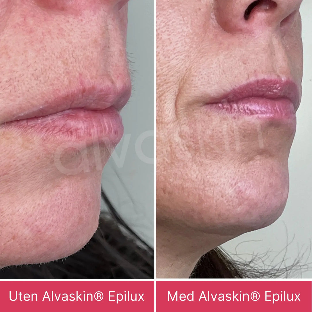 Alvaskin® Epilux
