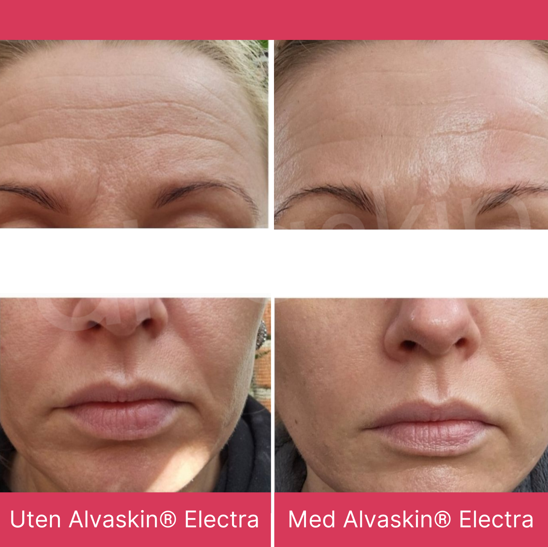 Alvaskin® Electra