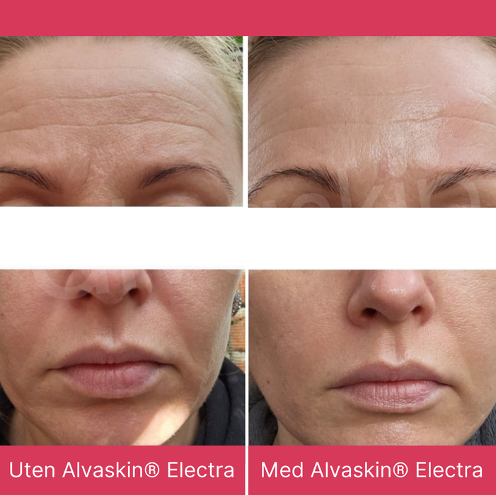 Alvaskin® Electra