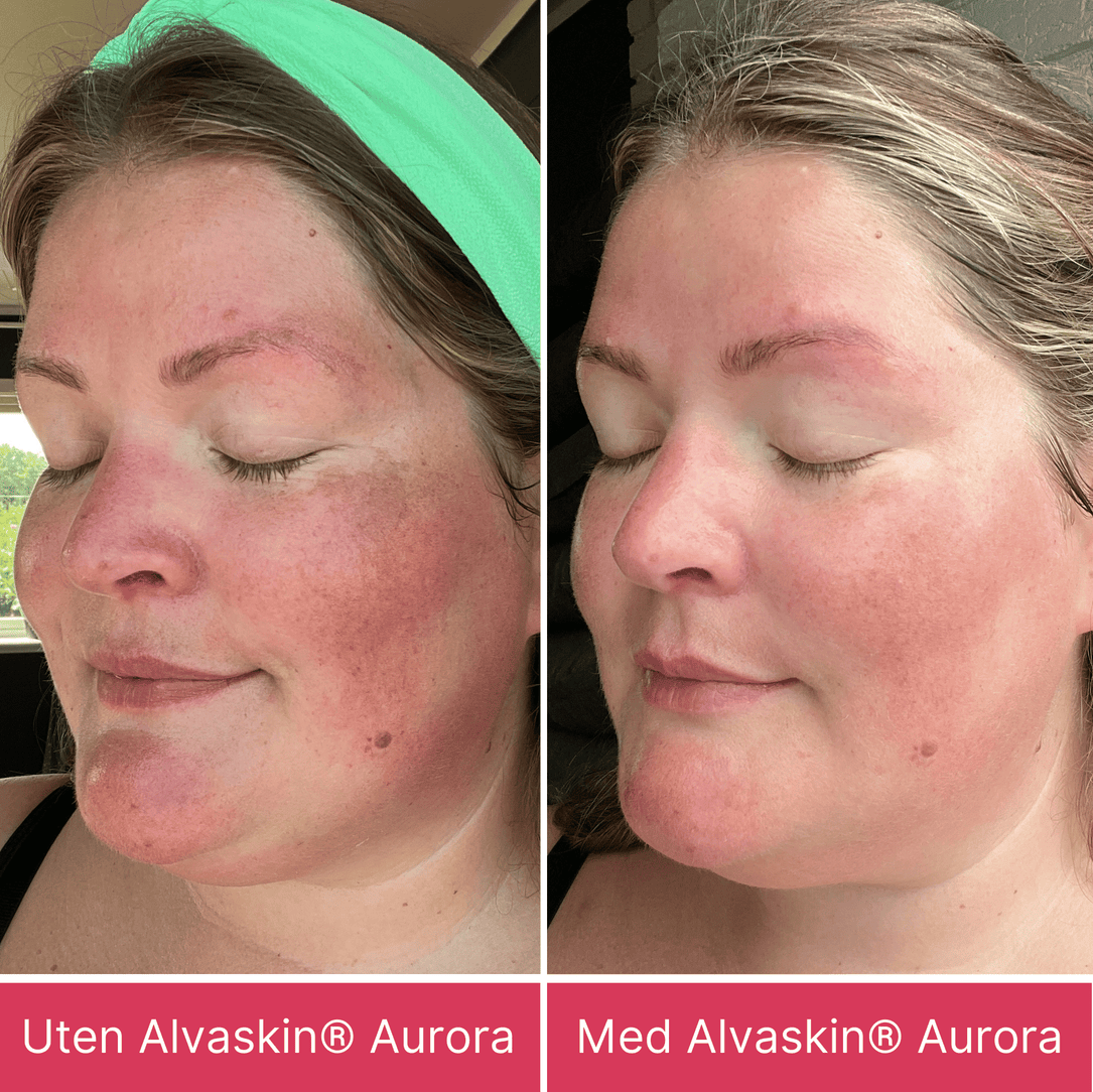 Alvaskin® Aurora
